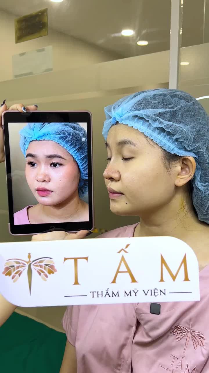 Tiktoker Phạm Như Ý (@y.phm) và khuôn mặt baby sau khi nâng mũi tại TMV Tấm