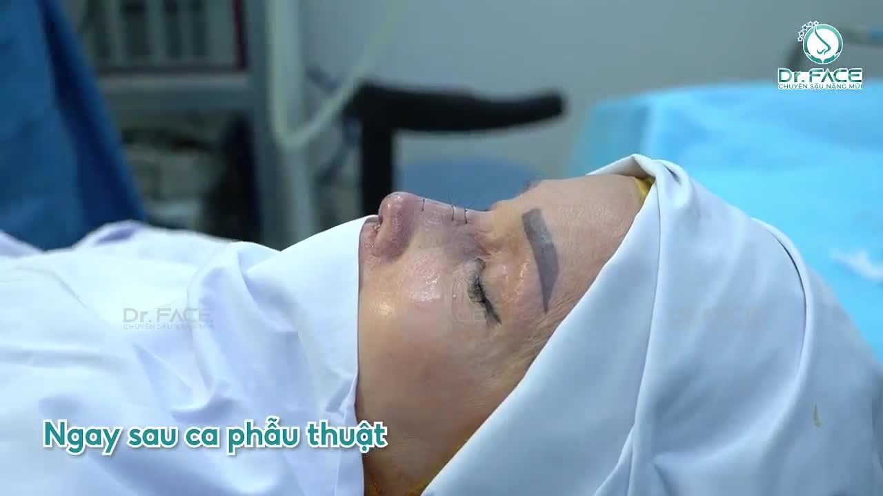 Mũi NÂNG 4 LẦN nay đã tháo thì bs có LÀM ĐƯỢC KHÔNG?