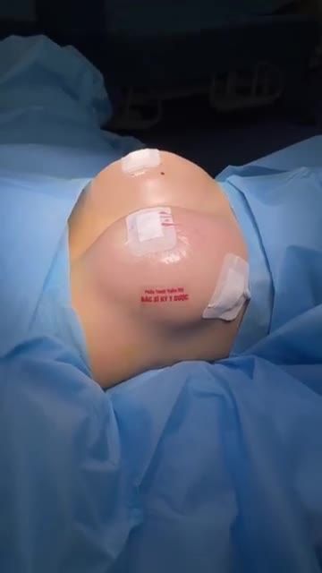 KẾT QUẢ VÒNG 1 SA TRỄ HÓA CĂNG TRÒN SAU KHI ĐƯỢC BÁC SĨ KỲ Y DƯỢC NHÀO NẶN