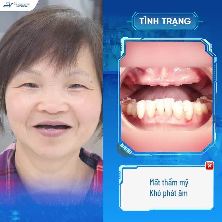 “BÕ CÔNG BAY TỪ SÉC VỀ VIỆT NAM TRỒNG RĂNG, CHẤT LƯỢNG KHÔNG THUA GÌ NƯỚC NGOÀI!”