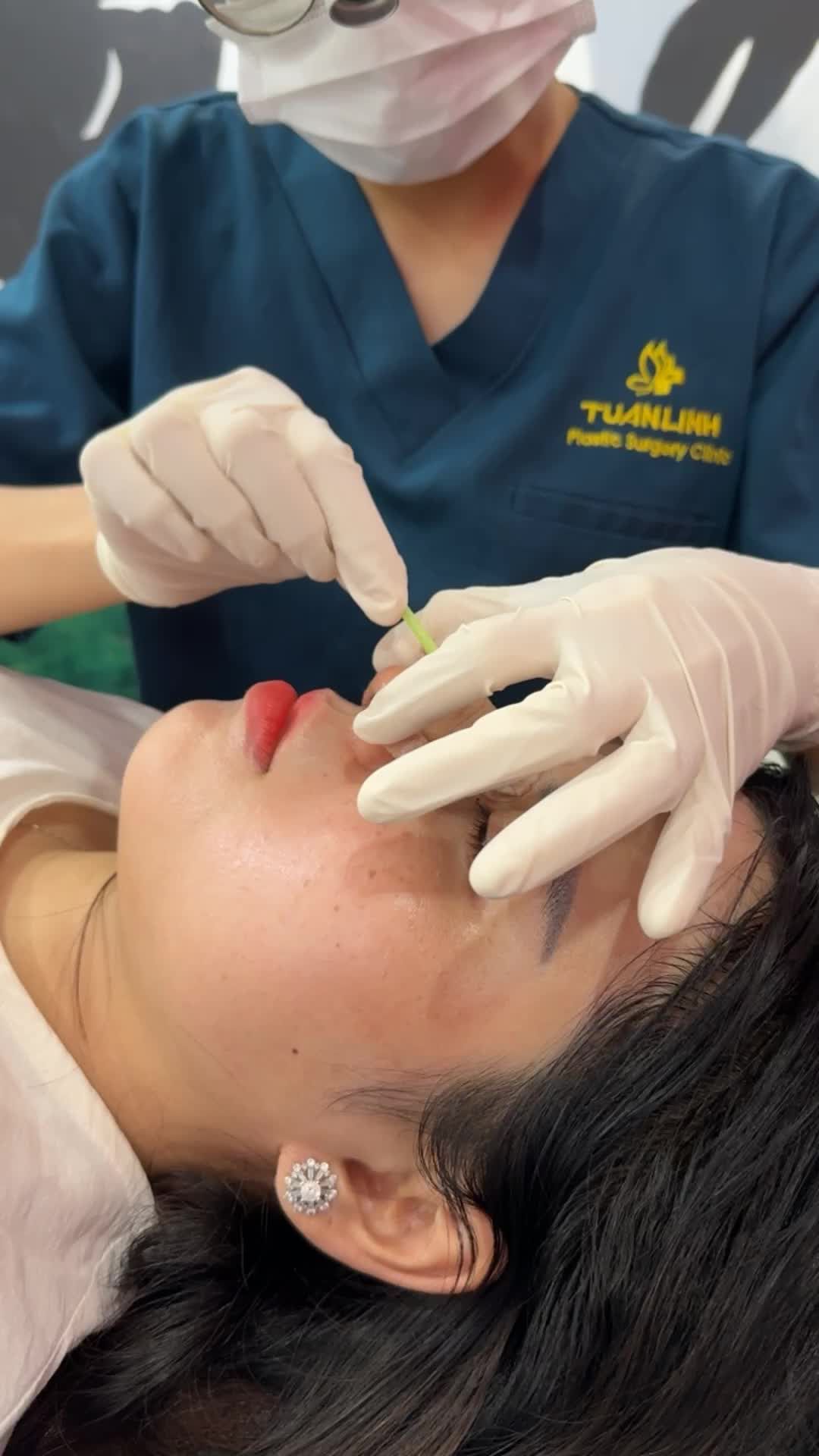 Case mũi cấu trúc vừa hoàn thành
