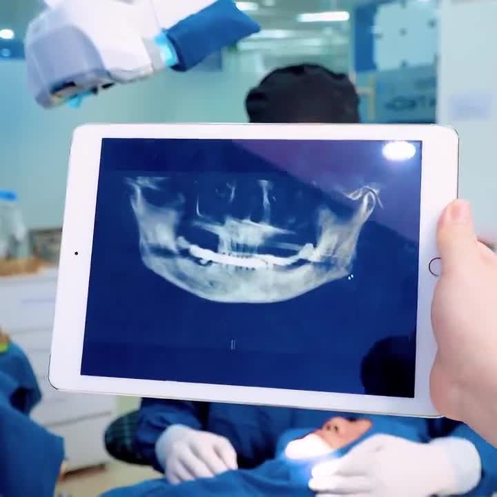 PHẪU THUẬT ĐẶT 6 TRỤ IMPLANT TOÀN HÀM TRÊN BẰNG CÔNG NGHỆ USI
