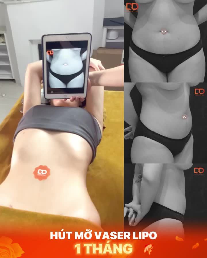 KHOE VÒNG EO THON GỌN SAU 1 THÁNG H.ÚT MỠ TẠI DRD