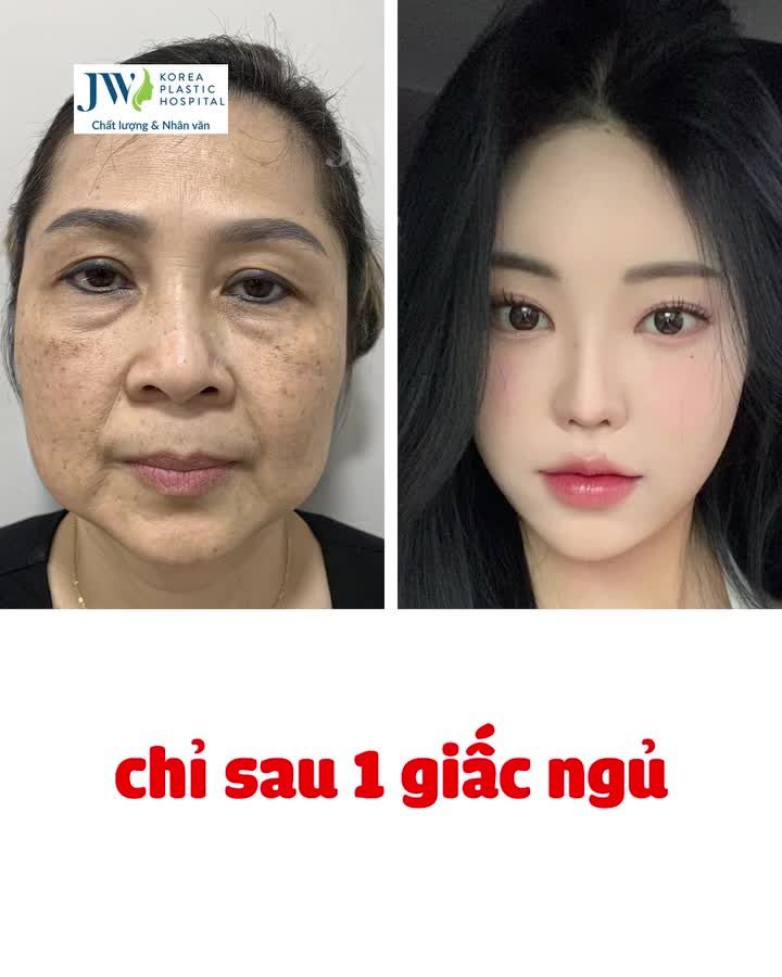 Nữ Việt kiều Na Uy U60 lấy lại NHAN SẮC U30 sau Căng da mặt Mesh Lift