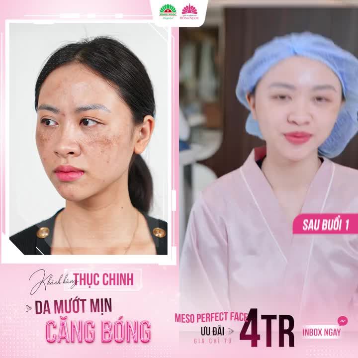 DA XUỐNG SẮC SAU SINH Mẹ bỉm sữa phản hồi như thế nào sau khi lấy lại được làn da căng bóng ngậm nước nhờ Meso Perfect Face.