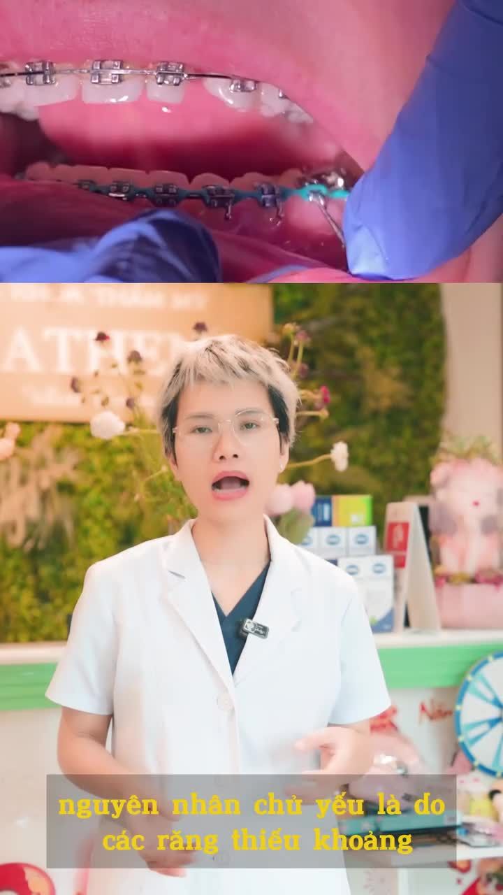 Tại sao càng niềng răng lại càng hô là như thế nào?