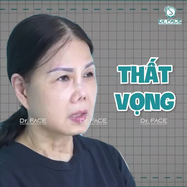 SỰ “HỒI SINH” kì diệu của CHIẾC MŨI BIẾN DẠNG sau 10 LẦN NÂNG
