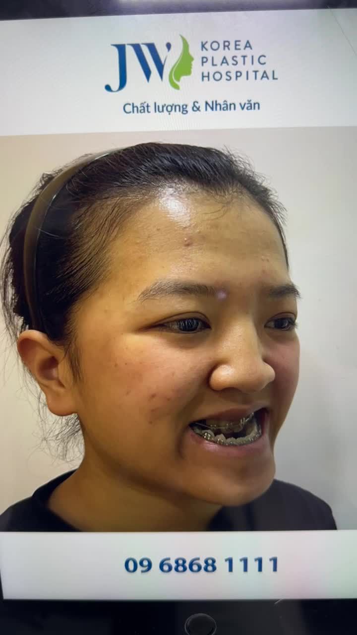 KHOE NHẸ kết quả PHẪU THUẬT 2 HÀM cho Nữ sinh GenZ gặp tình trạng MÓM NẶNG LÂU NĂM Giảm 38 Triệu Phẫu thuật 2 hàm, đăng ký tại đây: https://benhvienjw.com/sale80fb