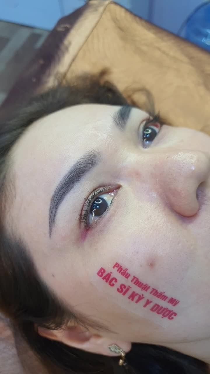 Sau 1 năm mở góc mắt trong, chị khách quay trở lại thực hiện phẫu thuật mở góc mắt ngoài, bác sĩ Kỳ Y Dược đã giúp khách hàng có được đôi mắt đẹp tự nhiên, khắc phục mọi khuyết điểm trước đó.