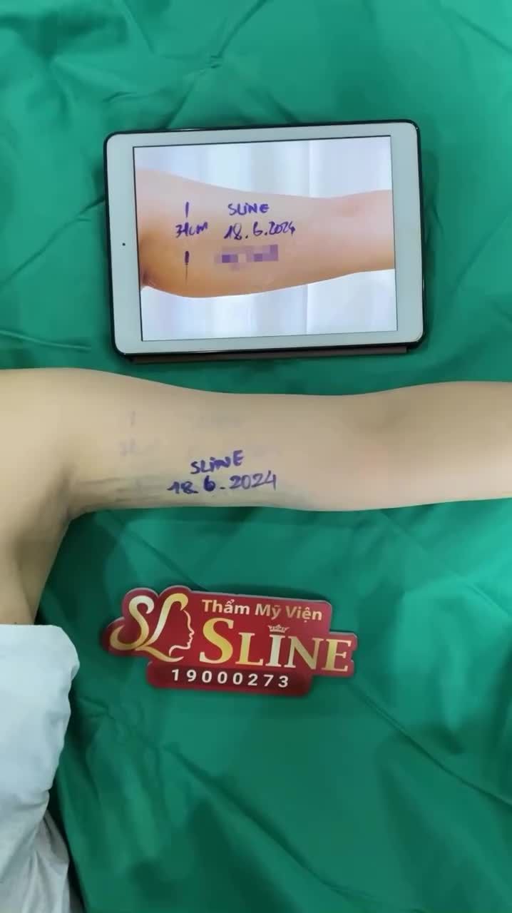 "Tuần sau em đi biển rồi, tuần này em hút mỡ cánh tay liệu có kịp không?"