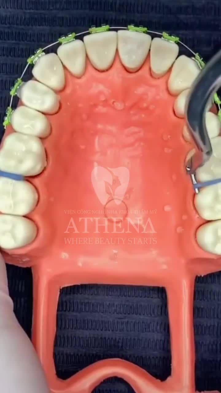 Nong hàm là một kỹ thuật được sử dụng trong quá trình chỉnh nha, nhằm tăng diện tích vòm miệng, tạo khoảng trống để các răng của hàm đó dịch chuyển dễ dàng hơn trong quá trình chỉnh nha.