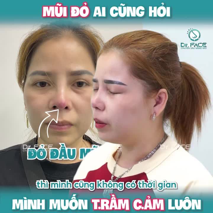 “MŨI ĐỎ ai cũng hỏi mình muốn TRẦM CẢM luôn”