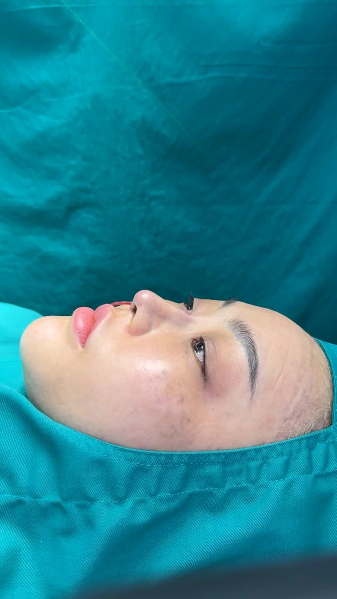 Case mũi cấu trúc sửa lại vừa hoàn thành
