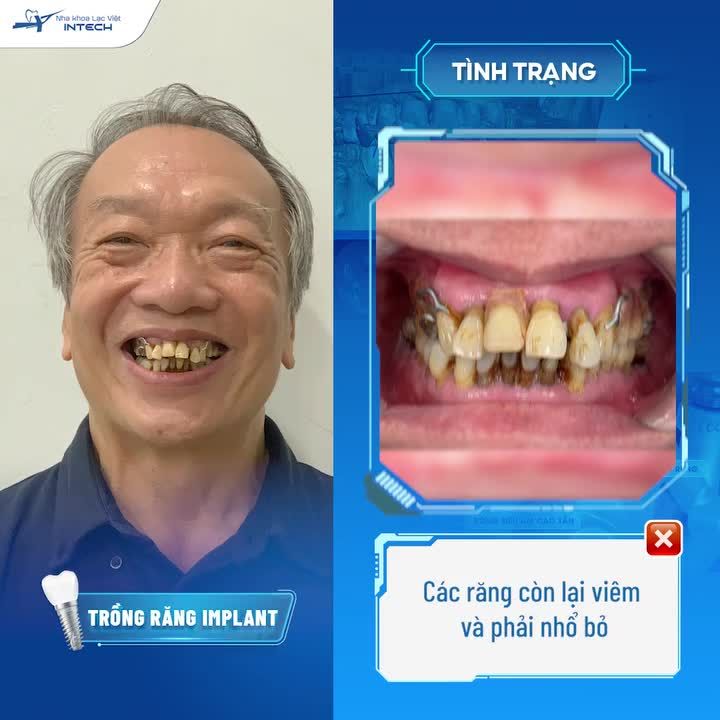 TRẺ RA CHỤC TUỔI CHỈ SAU 3 THÁNG TRỒNG RĂNG
