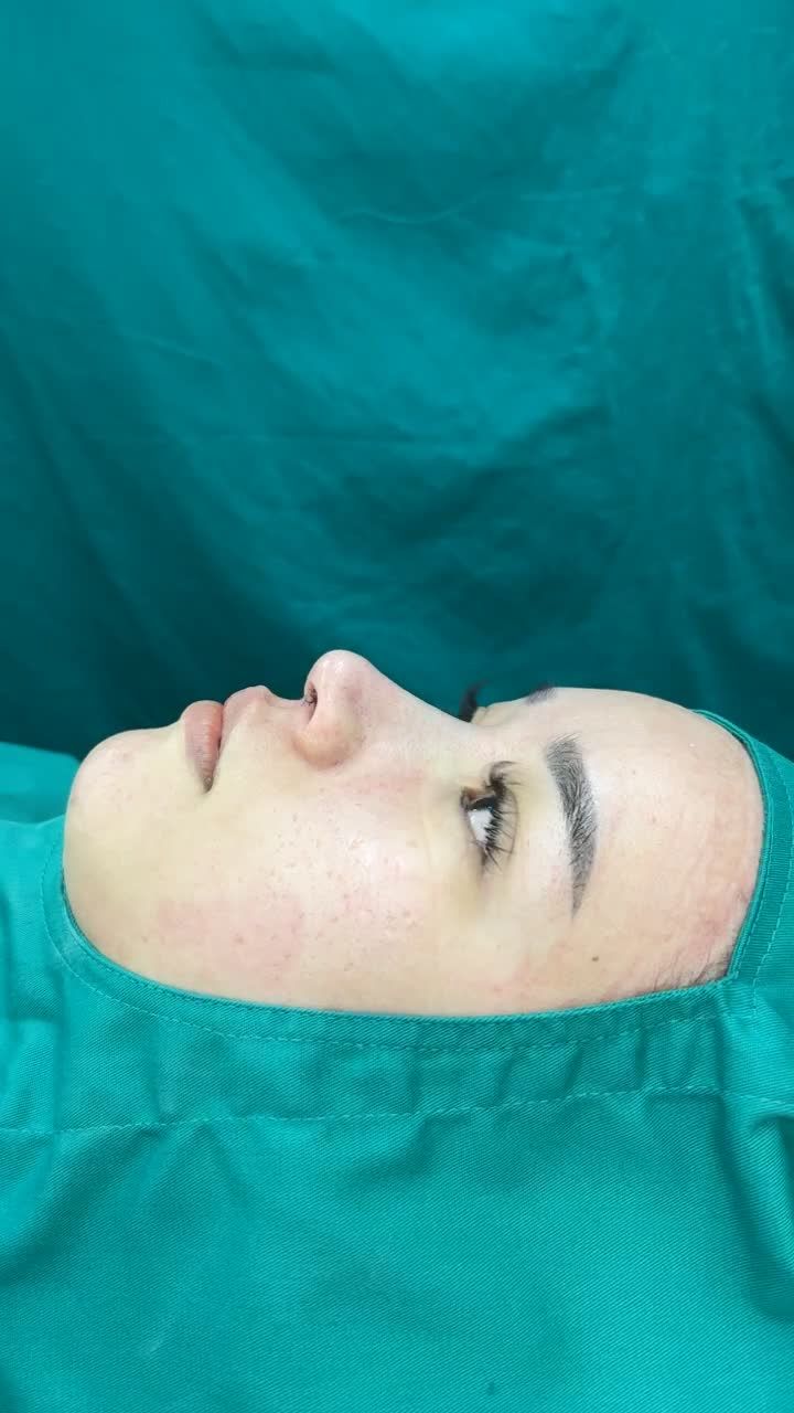 Case mũi cấu trúc bioform vừa hoàn thành