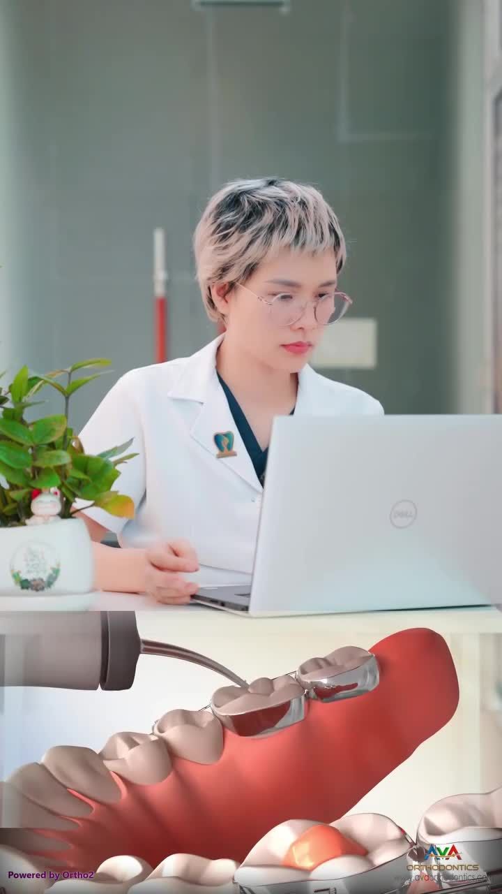 Tại sao răng cửa trên lại cắn chạm mắc cài răng cửa dưới? Cách xử lý