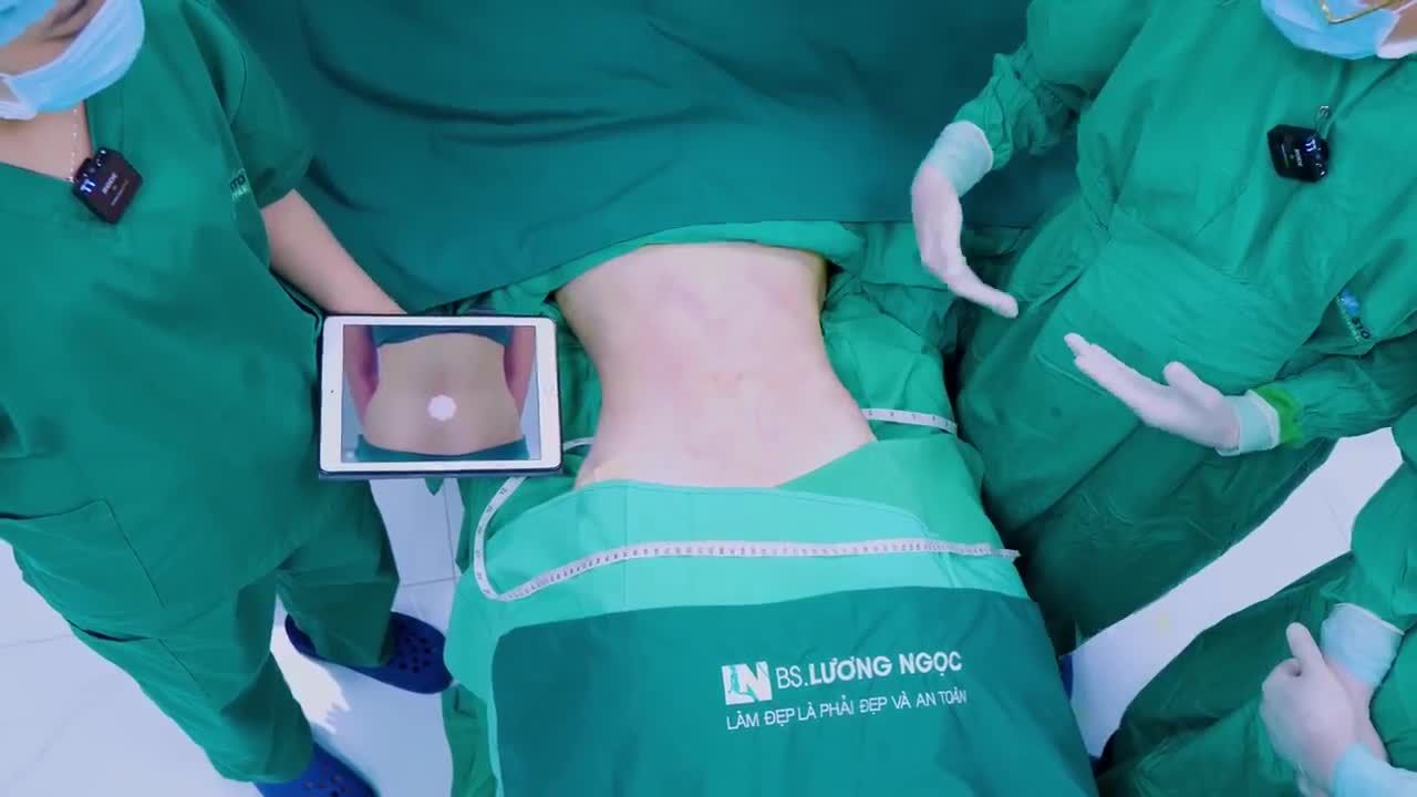 Mong muốn sở hữu vóc dáng hoàn hảo cùng vòng eo “con kiến” hàng ngàn chị em ao ước, chị H đã tìm đến ekip Bác sĩ Lương Ngọc và thực hiện dịch vụ HÚT MỠ TẠO DÁNG vùng bụng-eo-hông và nhận được kết quả vô cùng như ý: