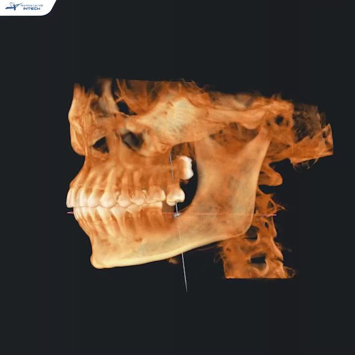 TỪNG "MẤT ĂN, MẤT NGỦ" VÌ RĂNG 37, KHÁCH HÀNG GIẢI QUYẾT NỖI LO NHANH CHÓNG SAU KHI CẤY GHÉP IMPLANT