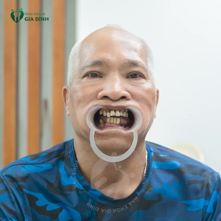 5 TIÊU CHUẨN LỰA CHỌN BÁC SĨ TRỒNG RĂNG IMPLANT