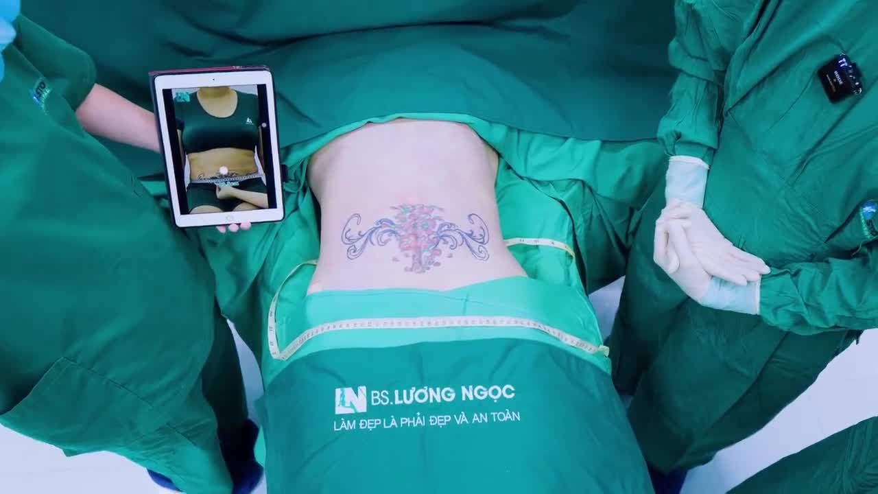 Không còn vòng bụng to, ngấn mỡ lâu năm chỉ sau 1 giờ thực hiện phương pháp HÚT MỠ TẠO DÁNG KHÔNG CẦN CĂNG CẮT DA