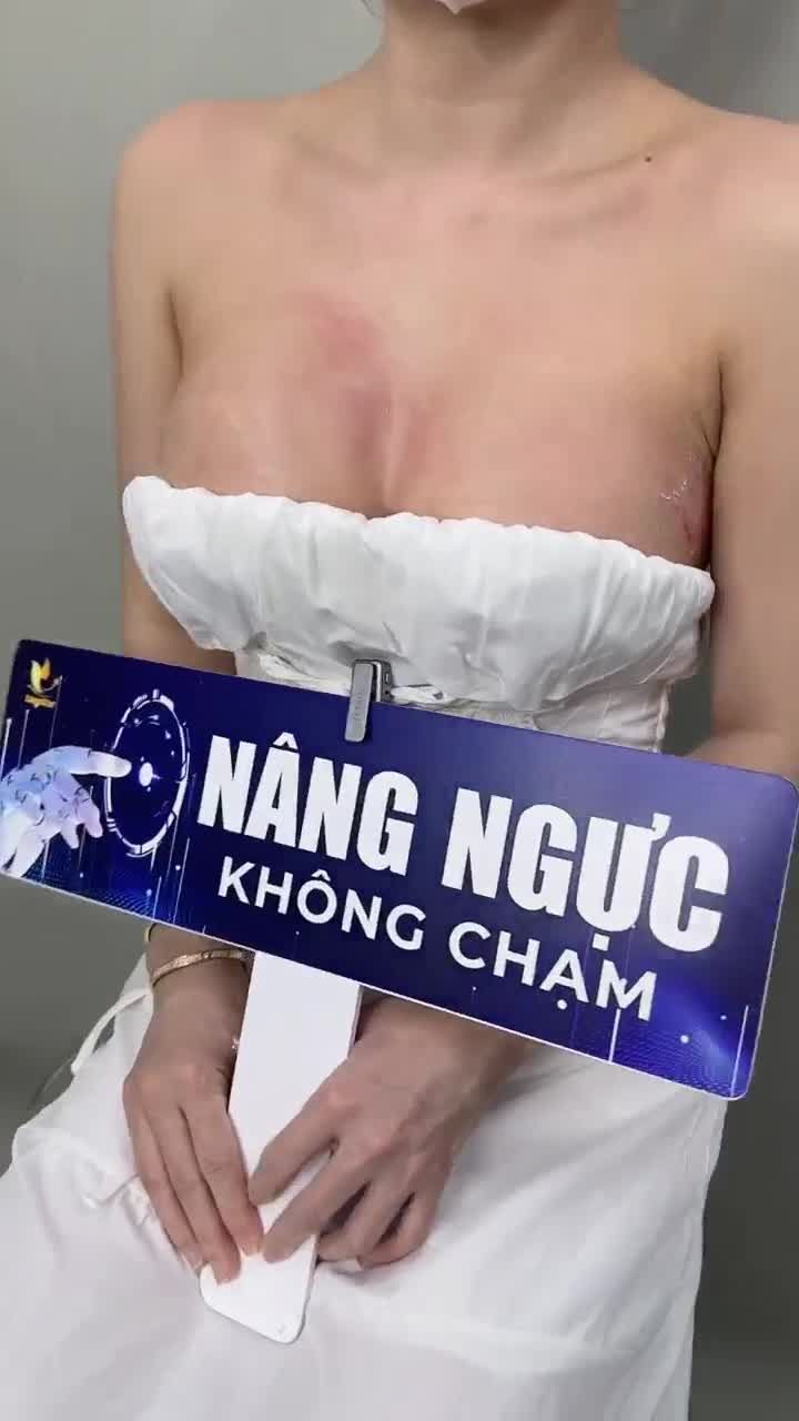 10 ngày NÂNG NGỰC KHÔNG CHẠM cho cô gái đến từ Bình Dương