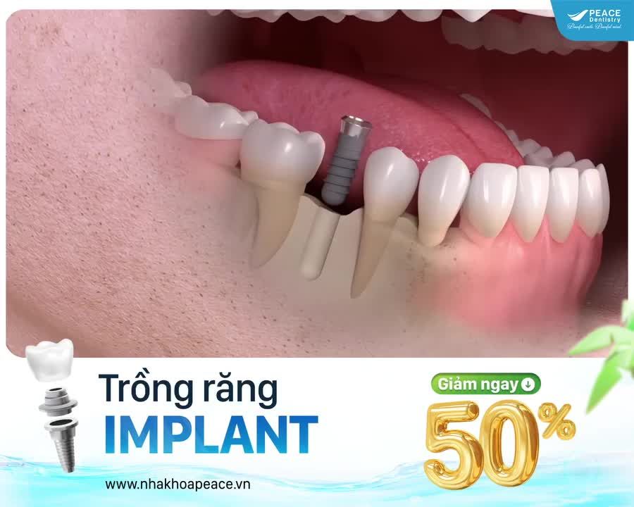 ƯU ĐÃI ĐẶC BIỆT - TRỒNG RĂNG IMPLANT GIẢM NGAY 50%