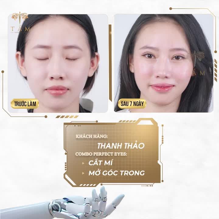 Cô nàng Thanh Thảo và hành trình thăng hạng nhan sắc với combo Perfect Eyes : Cắt mí - Mở góc trong tại Thẩm mỹ viện Tấm!