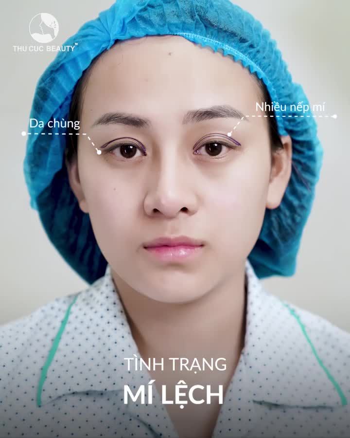 Cắt mí 3 ngày đã đẹp như này rồi thì chắc 7 ngày, 1 tháng sau nó còn phải đẹp hơn nữa