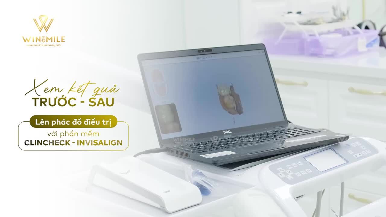 XEM KẾT QUẢ TRƯỚC - SAU NIỀNG VÀ LÊN PHÁC ĐỒ ĐIỀU TRỊ VỚI CLINCHECK - INVISALIGN