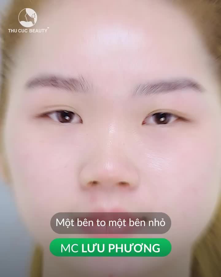 Thẩm mỹ TC cho khách hàng một đôi mắt cân đối, sắc
