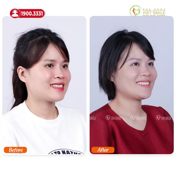 NIỀNG RĂNG Ở TUỔI U40 CÓ ĐẠT KẾT QUẢ TỐT?