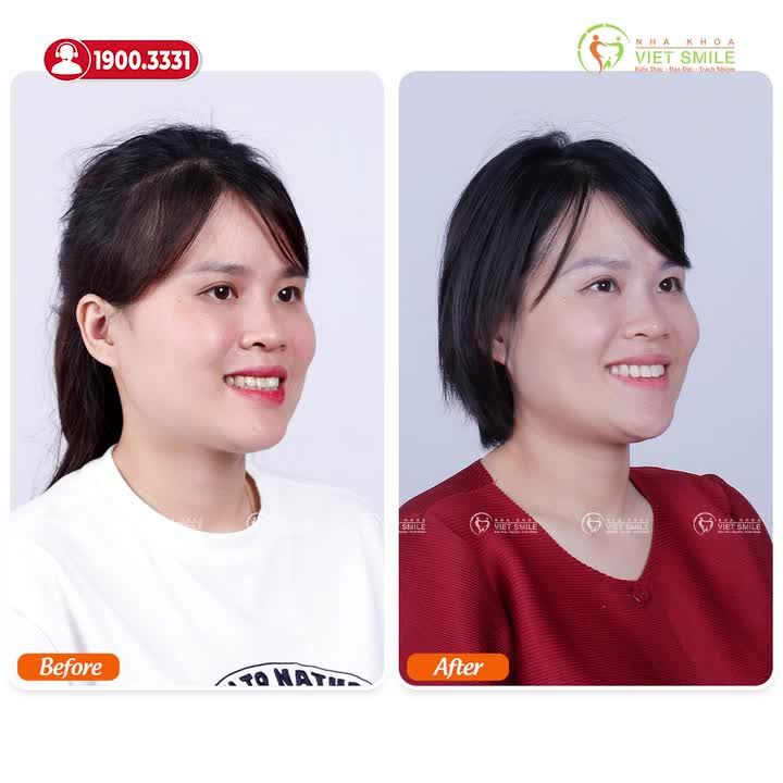 NIỀNG RĂNG Ở TUỔI U40 CÓ ĐẠT KẾT QUẢ TỐT?