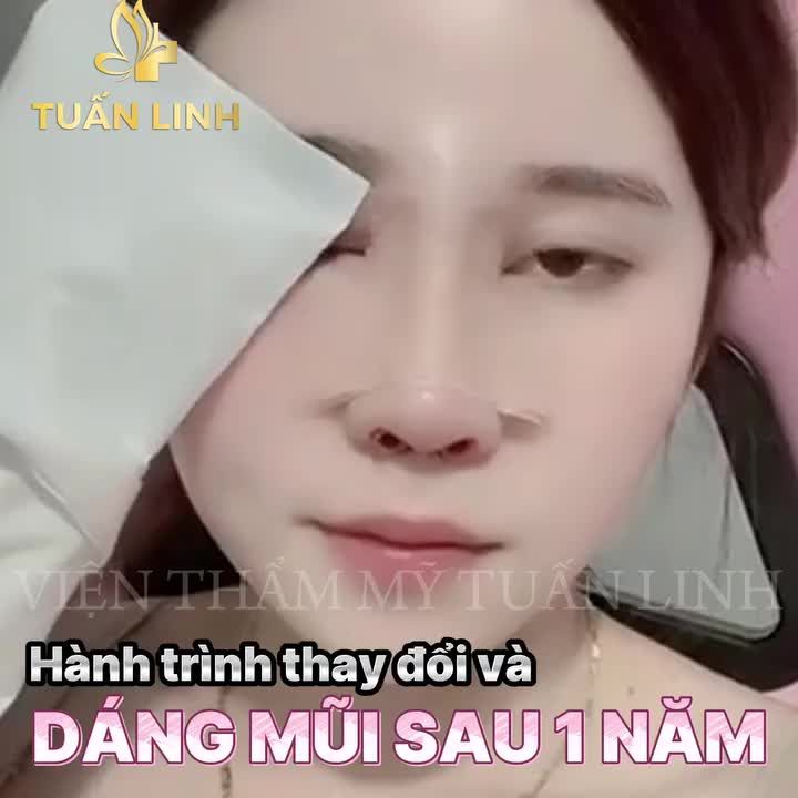 Hành trình nâng mũi cấu trúc Dáng mũi sau 1 năm thực hiện của bạn T.D!!