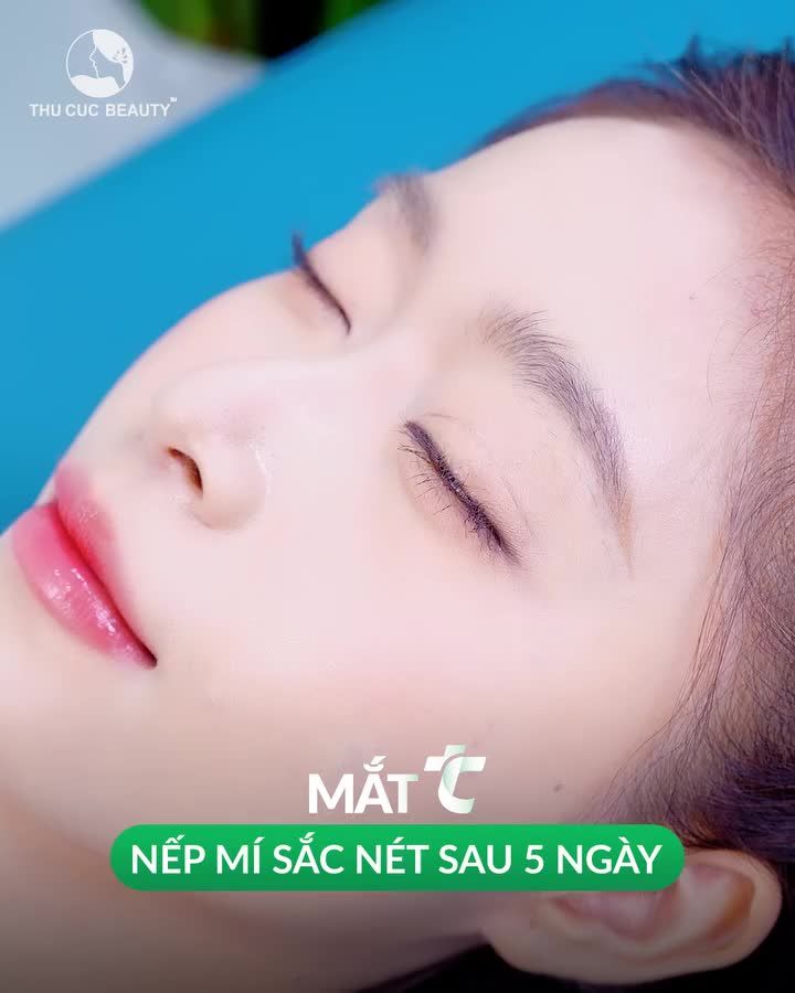 Tự ti, ngại giao tiếp vì mí sụp, mắt thiếu sức sống