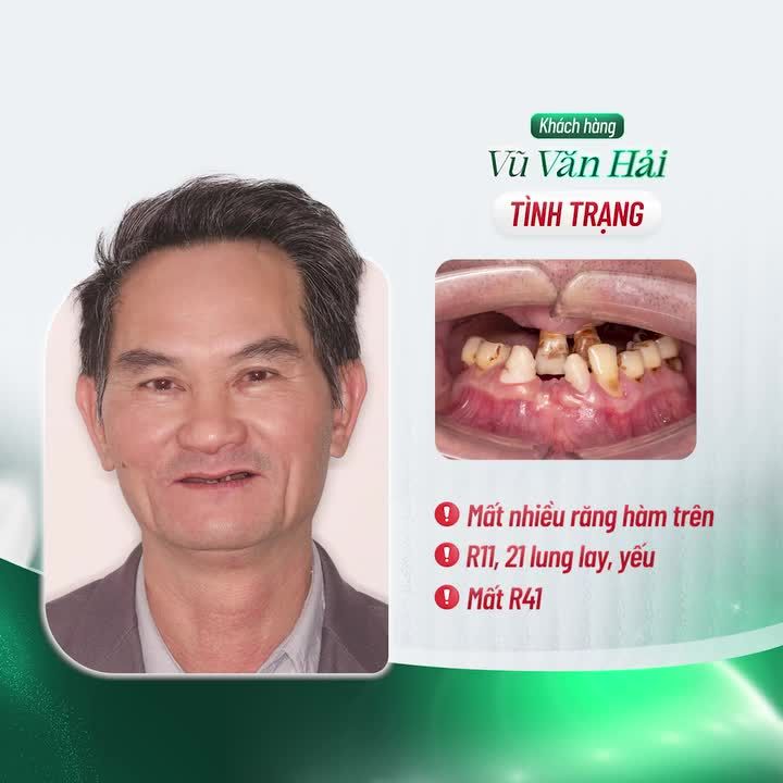 TRỒNG RĂNG IMPLANT TOÀN HÀM KHẮC PHỤC TẤT CẢ CÁC NHƯỢC ĐIỂM CỦA HÀM THÁO LẮP