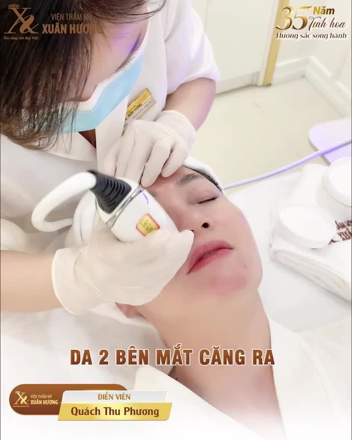 Ulthera RF đã xóa nhăn mắt hiệu quả như thế nào?