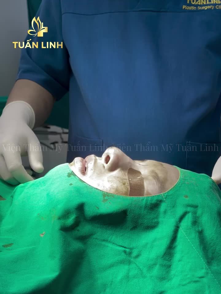 Tháo sóng Surgiform có lâu và phức tạp không??