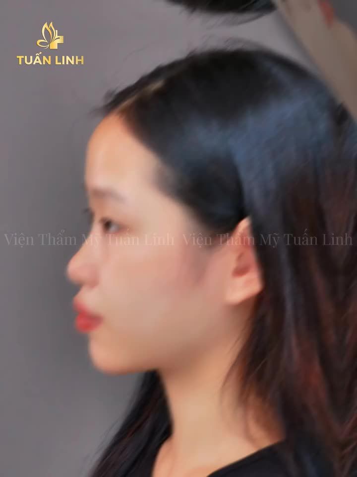 Mũi đẹp như ý chi phí nhỏ xíu
