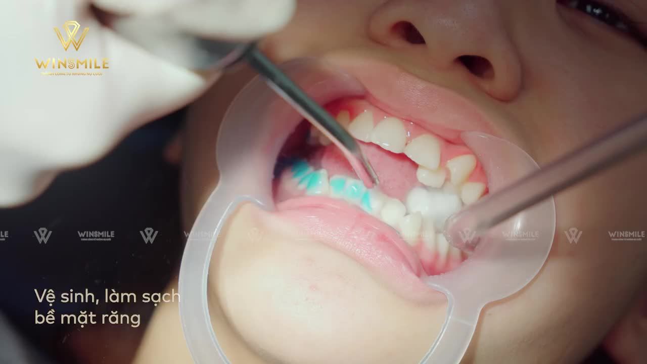 CẬN CẢNH QUÁ TRÌNH GẮN MẮC CÀI KIM LOẠI THƯỜNG TẠI WIN SMILE