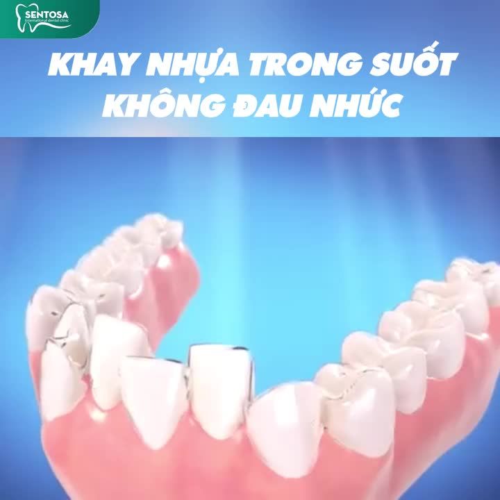 CÙNG CON NIỀNG RĂNG THOẢI MÁI, KHÔNG ĐAU LÀ ĐIỀU QUAN TRỌNG NHẤT