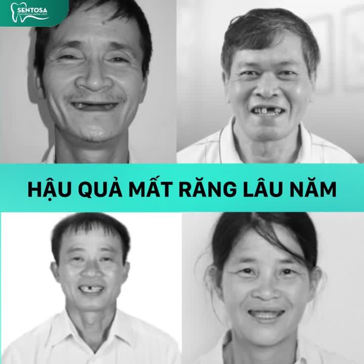 90% TÌNH TRẠNG MẤT RĂNG VĨNH VIỄN NHƯNG VẪN CHỦ QUAN