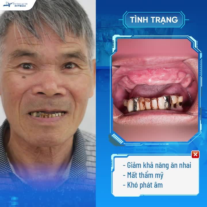 KHỔ SỞ VÌ MẤT RĂNG LÂU NĂM, U70 LẤY LẠI HÀM RĂNG CHẮC KHỎE NHỜ CÔNG NGHỆ TRỒNG RĂNG DCT