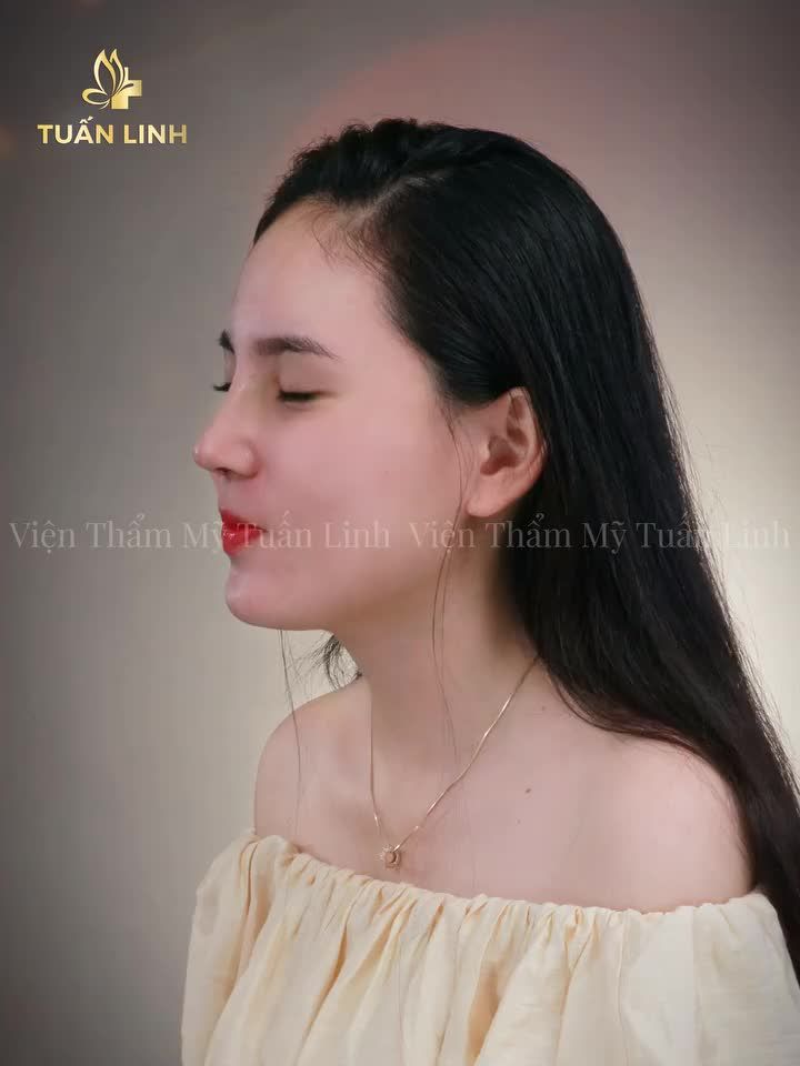 Chia sẻ cảm nhận của khách hàng sau khi tham gia chương trình nâng mũi 0 ĐỒNG và may mắn trúng giải, thực hiện phẫu thuật có được chiếc mũi xinh ưng ý