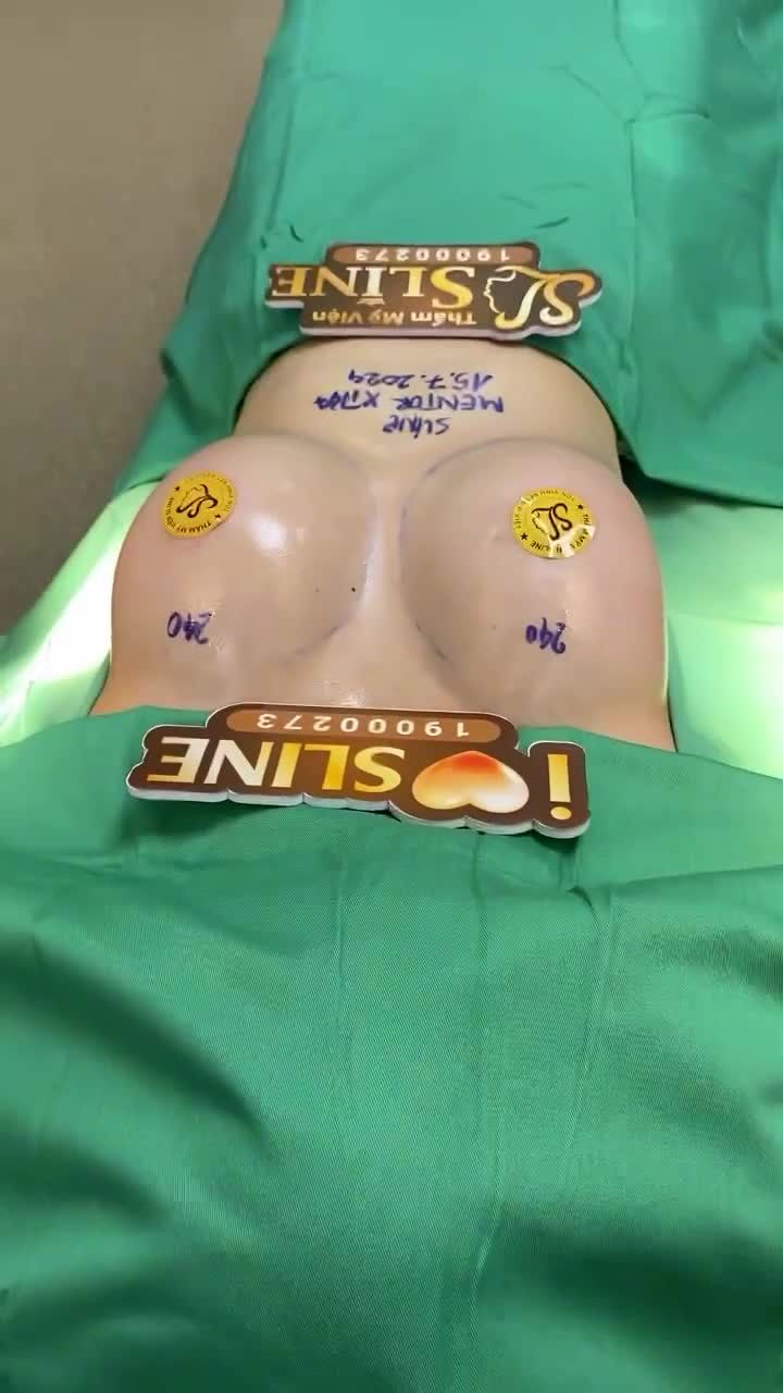 ĐẶT TÚI SIZE NHỎ 240CC NHƯNG...  Kết quả V1 trông vẫn đầy đặn và sexy như những bạn đặt size 320CC
