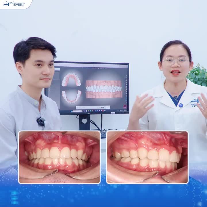 "RẤT LÀ SÁNG SUỐT KHI ĐÃ QUYẾT ĐỊNH NIỀNG RĂNG X-MATRIX TẠI LẠC VIỆT INTECH ..."