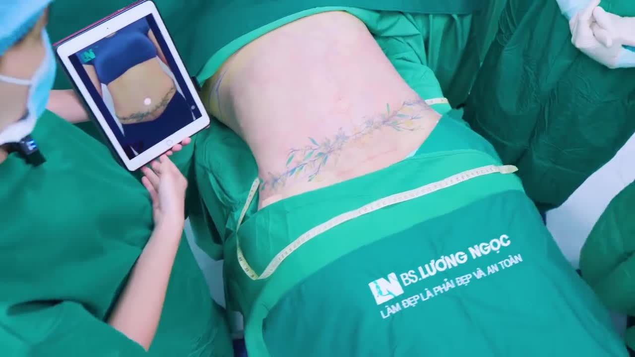 Dù đã từng thực hiện phẫu thuật cắt da tạo hình thành bụng, chị Kim Phượng vẫn chưa hài lòng với kết quả 