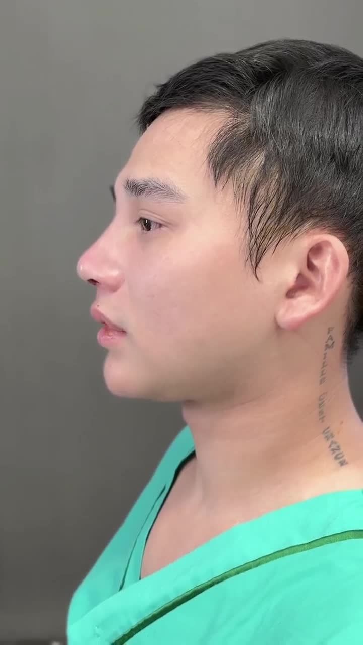 Nâng mũi nam - Nâng tầm thần thái - Đẹp chuẩn Men!!