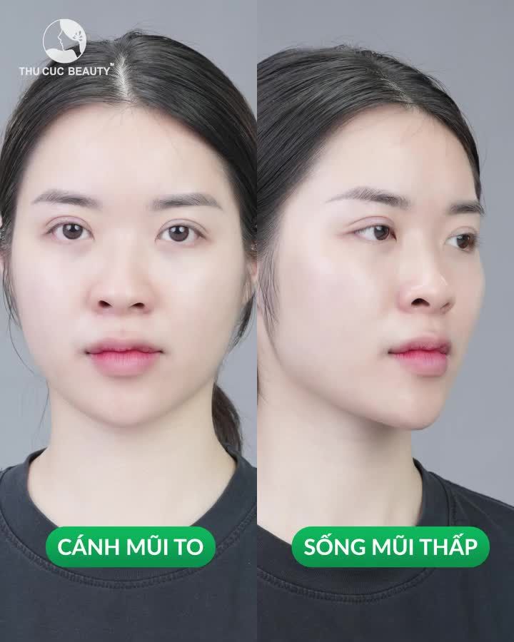 Hot girl Khánh Hòa đã thay đổi thế nào sau nâng mũi?
