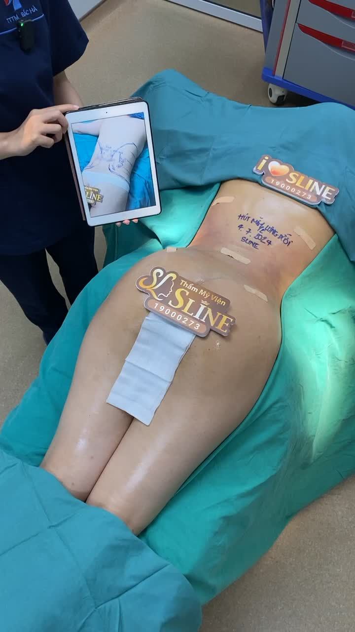 CA HÚT MỠ SỐ 2 TRONG NGÀY