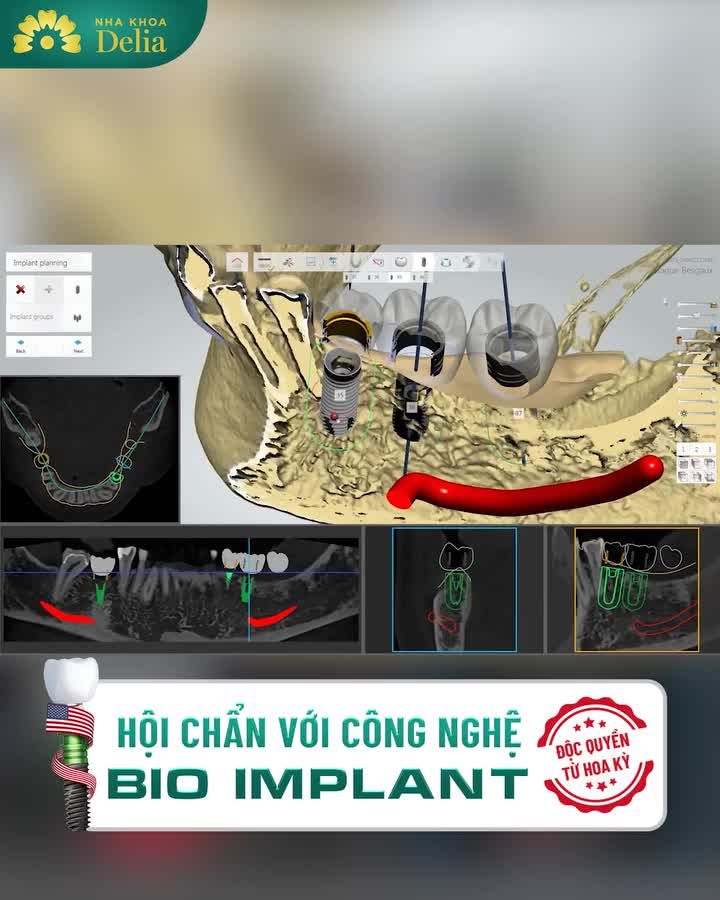 Cô/chú/anh/chị BIẾT GÌ CHƯA?  ĐẶC QUYỀN dành cho khách hàng TRỒNG RĂNG chỉ có tại DELIA